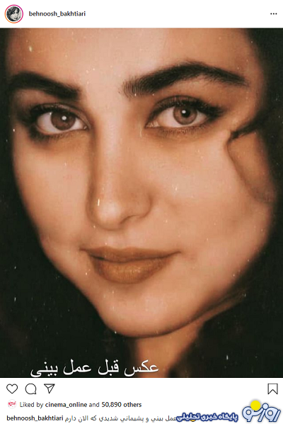 عکس بینی بهنوش بختیاری قبل و بعد از عمل!