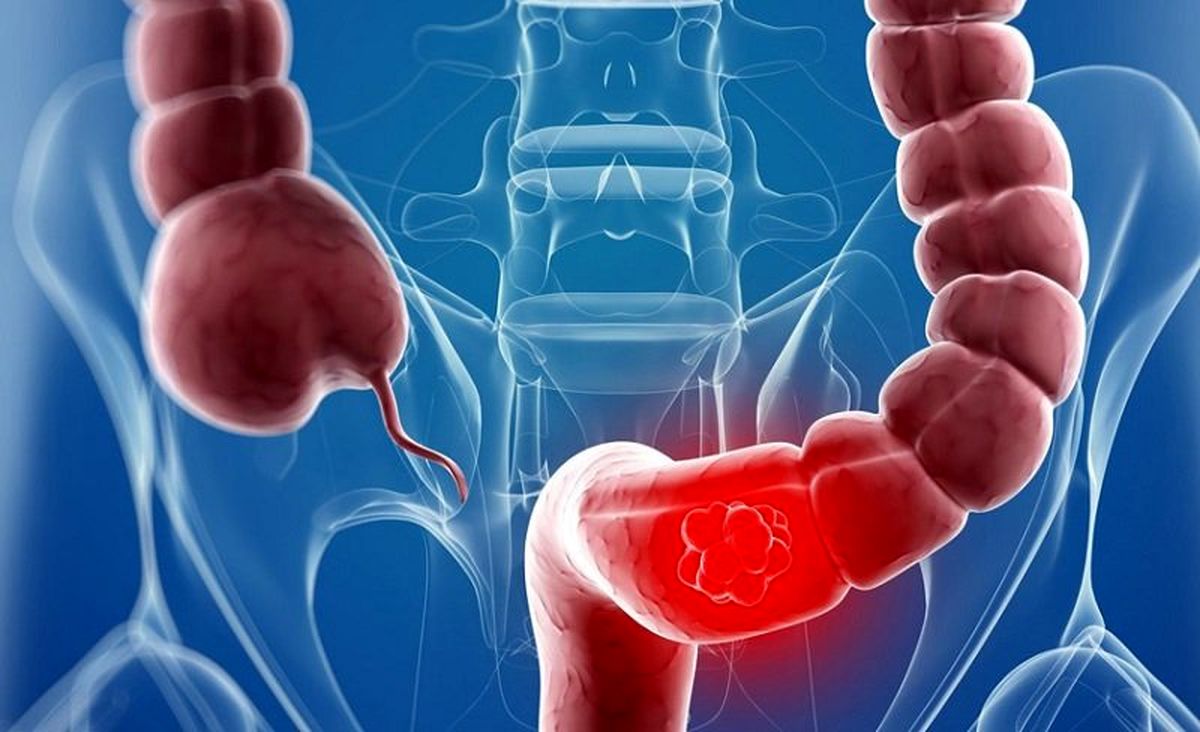 هفت عامل مهم که خطر ابتلا به سرطان روده را افزایش میدهند؟ هفت عامل مهم که خطر ابتلا به سرطان روده را افزایش میدهند؟