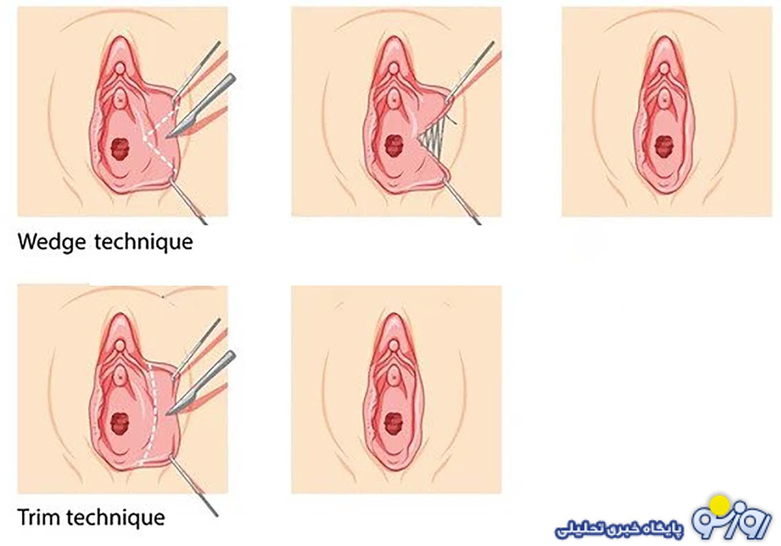 همه چیز درباره لابیاپلاستی؛ از شناخت تا انتخاب
